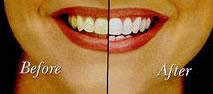 Teeth whitening before and after